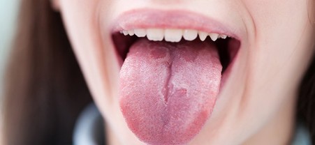 Glositis Migratoria Benigna O Lengua Geogr fica Blogs Quir nsalud glositis-migratoria-benigna-o-lengua-geogr-fica-blogs-quir-nsalud